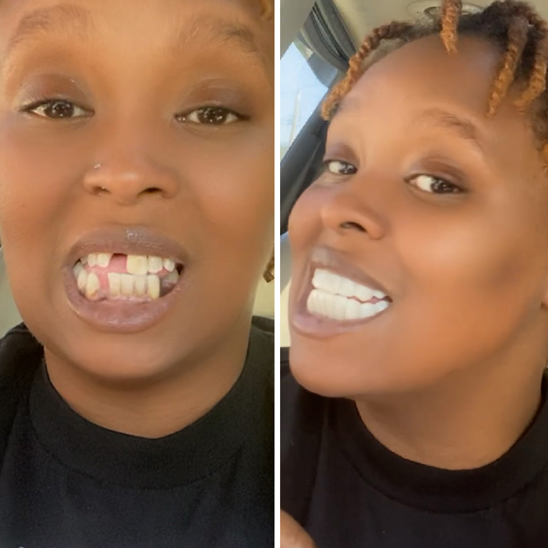 ¡Pop On Veneers es IT!