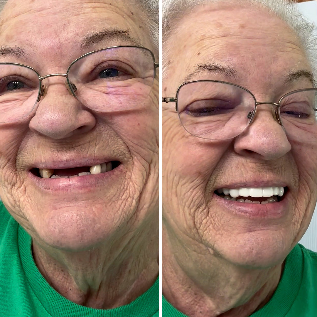 ¡Consigue una sonrisa plena con las Carillas Pop On!