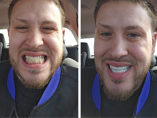 Sonriendo con confianza con mis carillas Pop On.