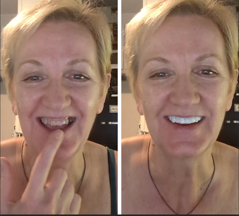 ¡POP en tu nueva sonrisa!