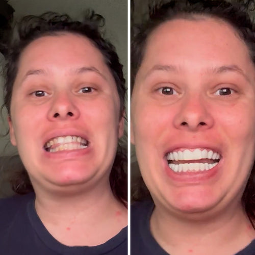 ¡100% recomiendo estas carillas!