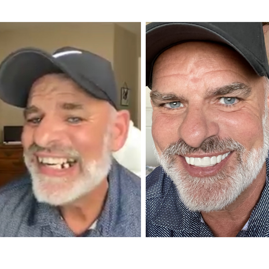 PopOnVeneers es un regalo de Dios.