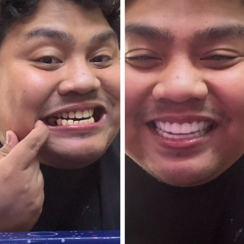 ¡Las Carillas Pop On son un milagro!