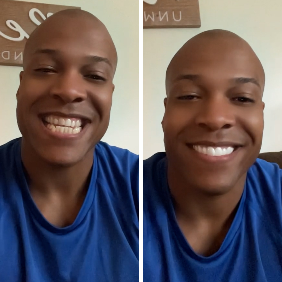 ¡Me encantan mis Pop On Veneers!