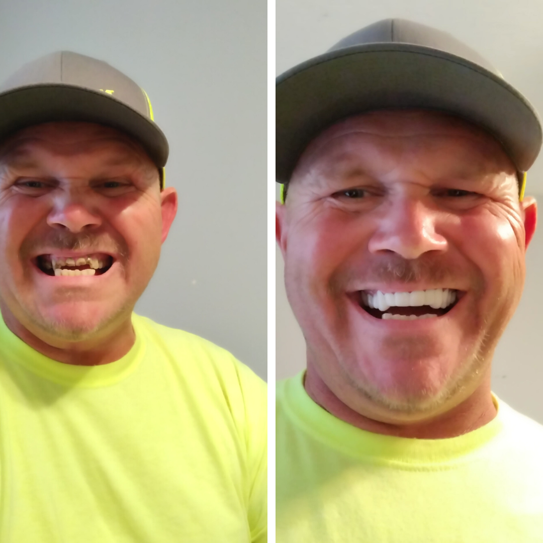 ¡Es fácil con Pop On Veneers!