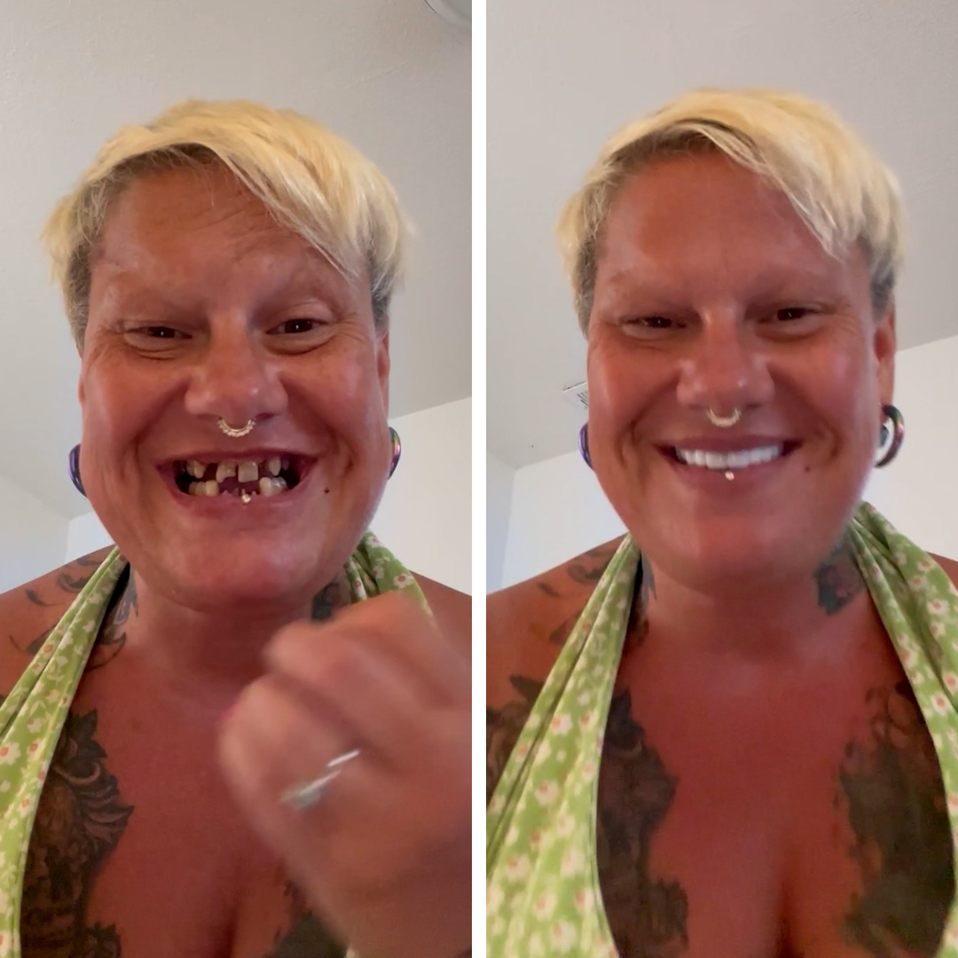 Las carillas Pop On son increíbles.