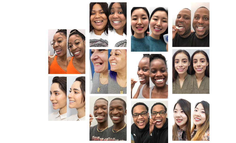 Check out pictures and videos of customers smile journeys. You can see pictures of color options for your new smile from Pop On Veneers! Hollywood white, Natural white, Mature Tan