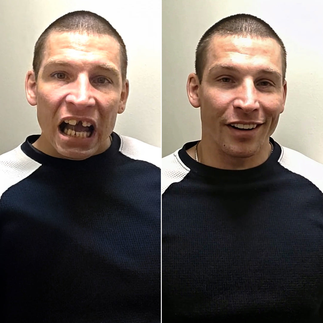 These veneers just pop right on