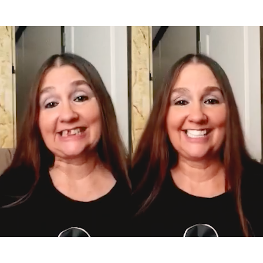 Evolución de mi sonrisa