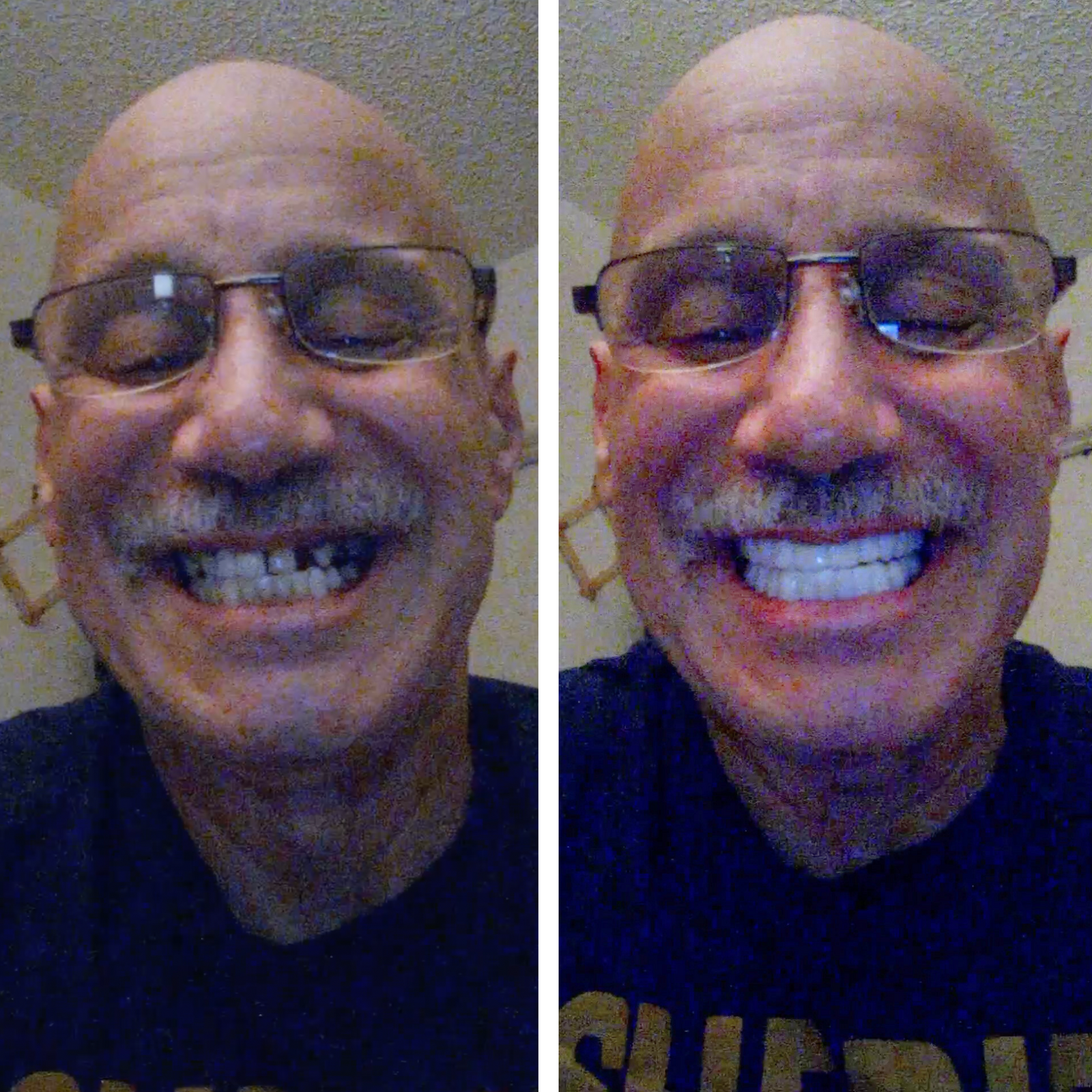 Mi nueva sonrisa es increíble.