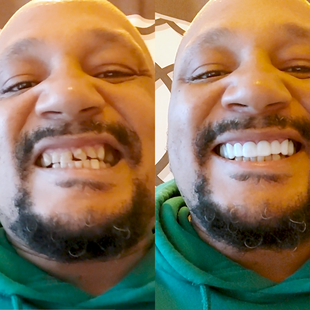 De los dientes astillados, a una sonrisa INCREÍBLE.