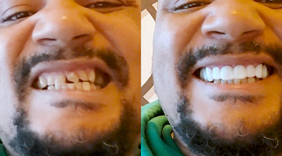 From chipped teeth, to an AMAZING smile!