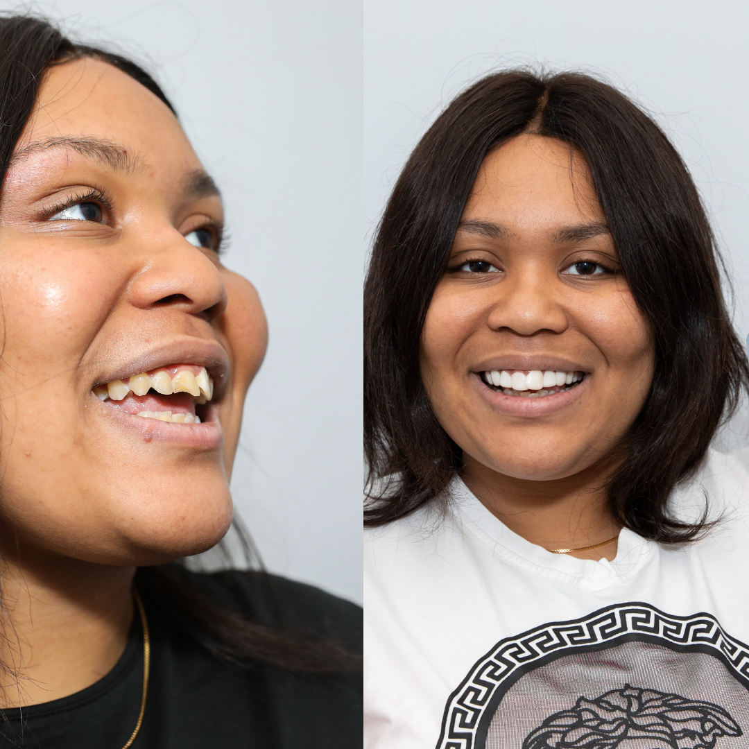 Adiós al diente astillado