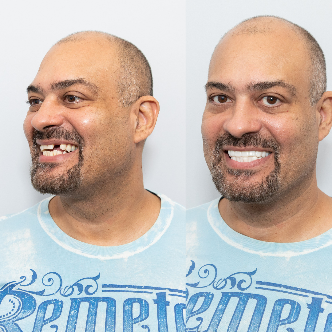 ¡No más flipper! ¡No más dientes perdidos!