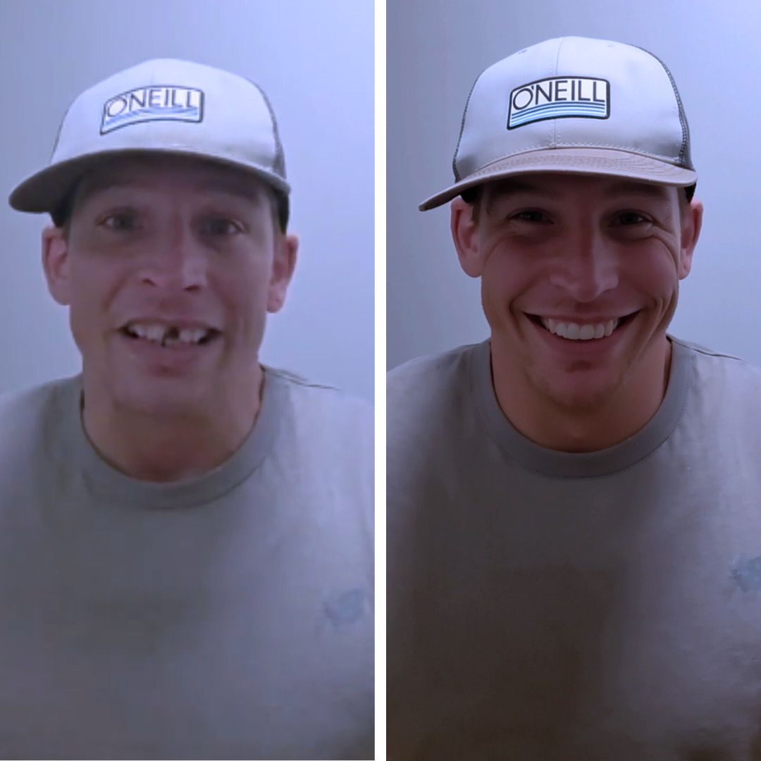 These veneers are a JOB SAVER!