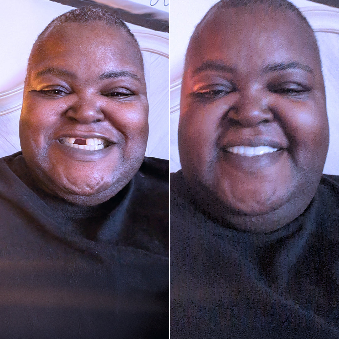 ¡He recuperado mi sonrisa a los 55 años!