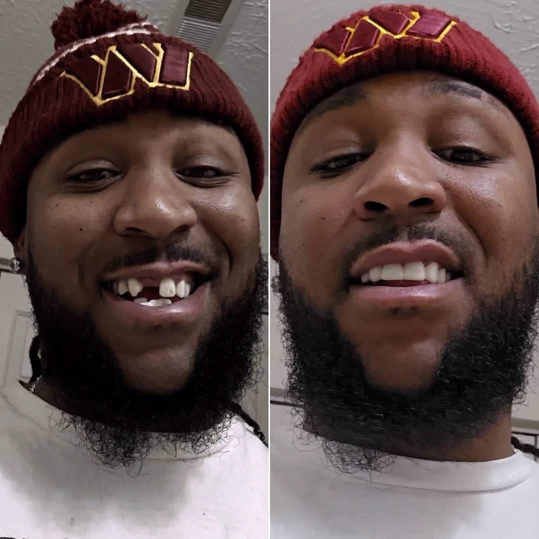 falta de dientes frontales, confianza, espaciado dental, sonrisa más completa