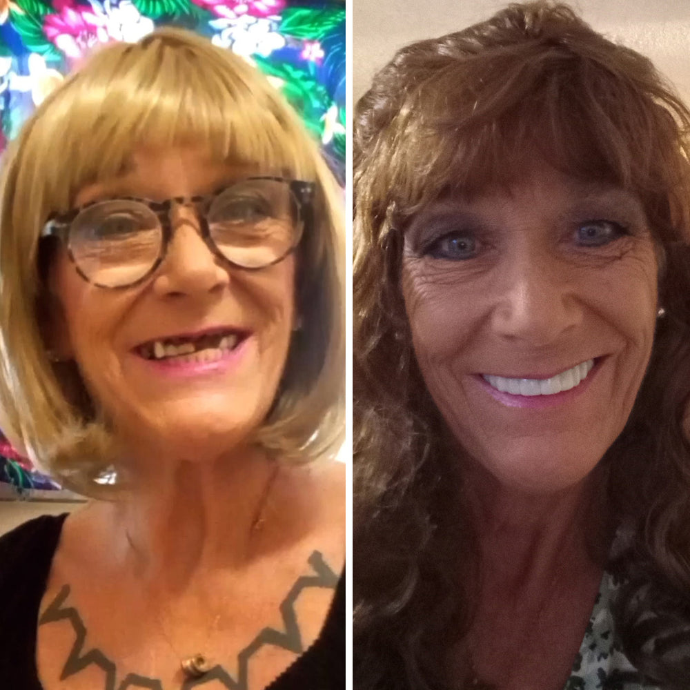 Smile Stories – Pop On Veneers