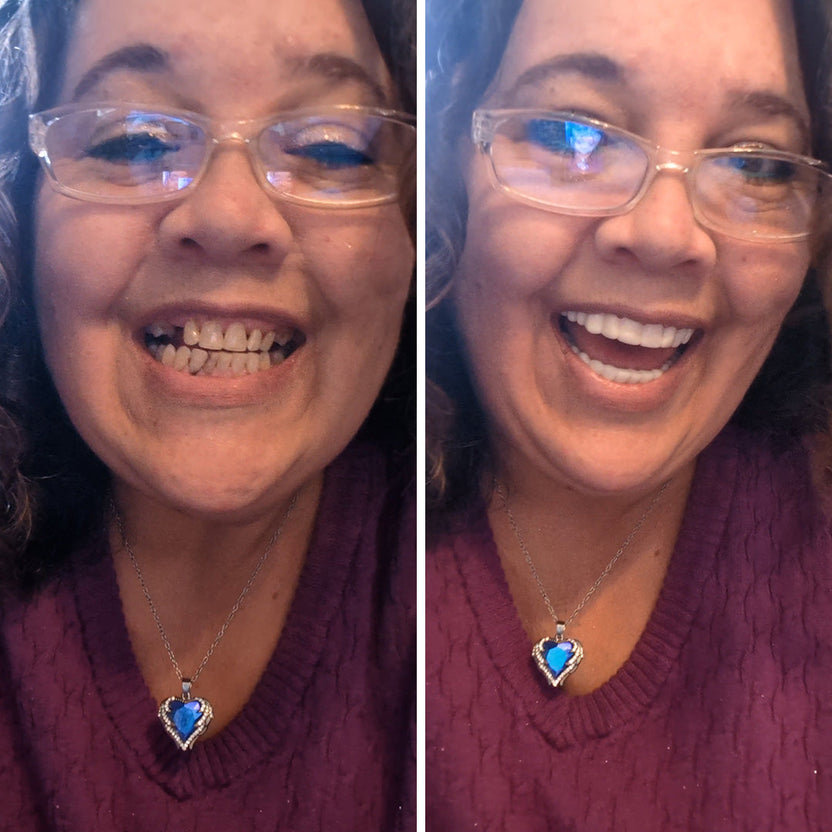 Confidence restored! – Pop On Veneers