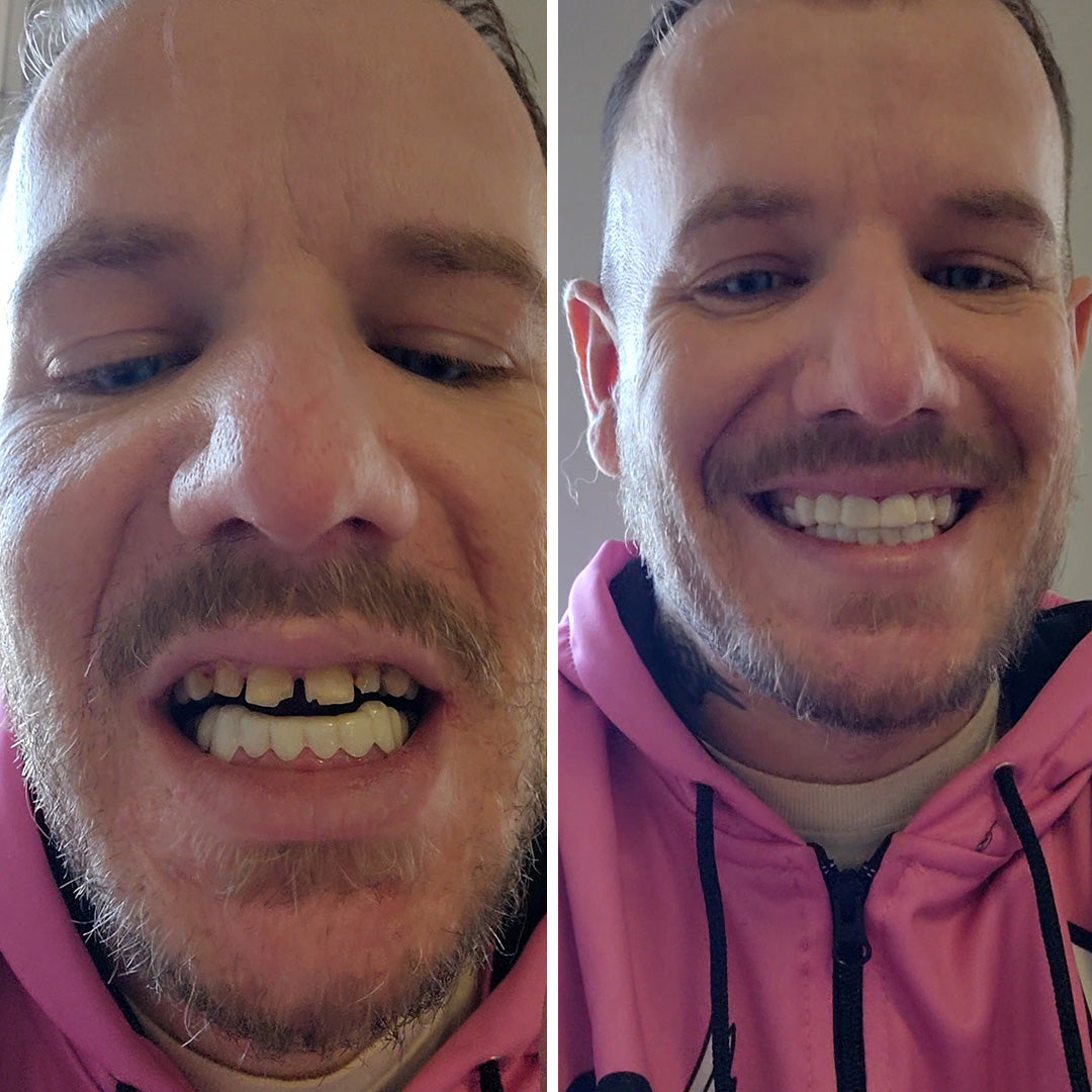 Me siento genial con mi nueva sonrisa