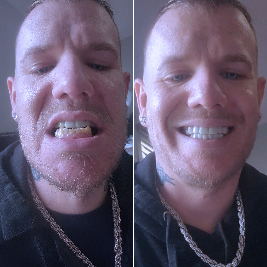 ¡Pop On Veneers me ha devuelto la sonrisa!