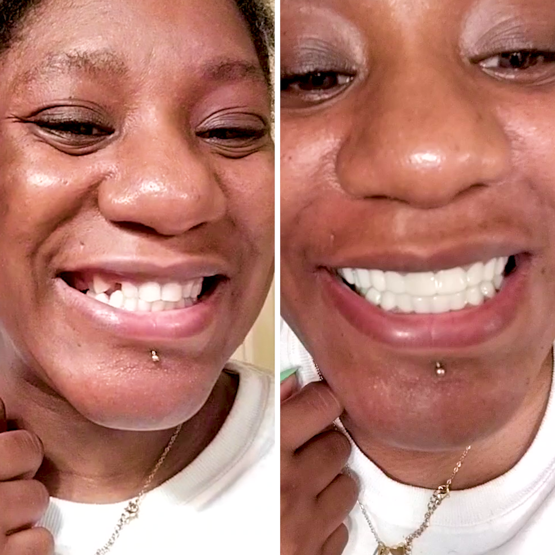 Great experience start to finish! Pop on Veneers