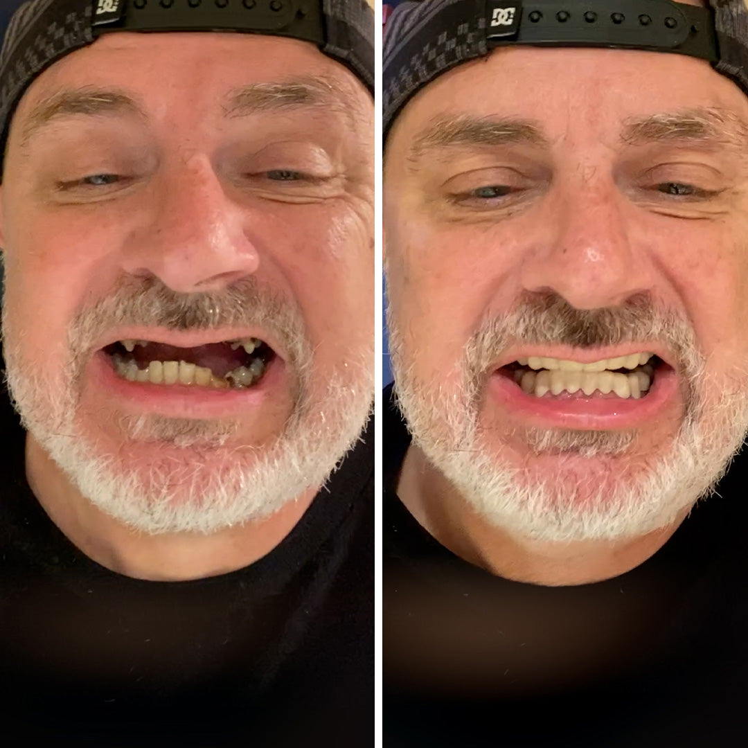 Estas carillas me dan una sonrisa perfecta