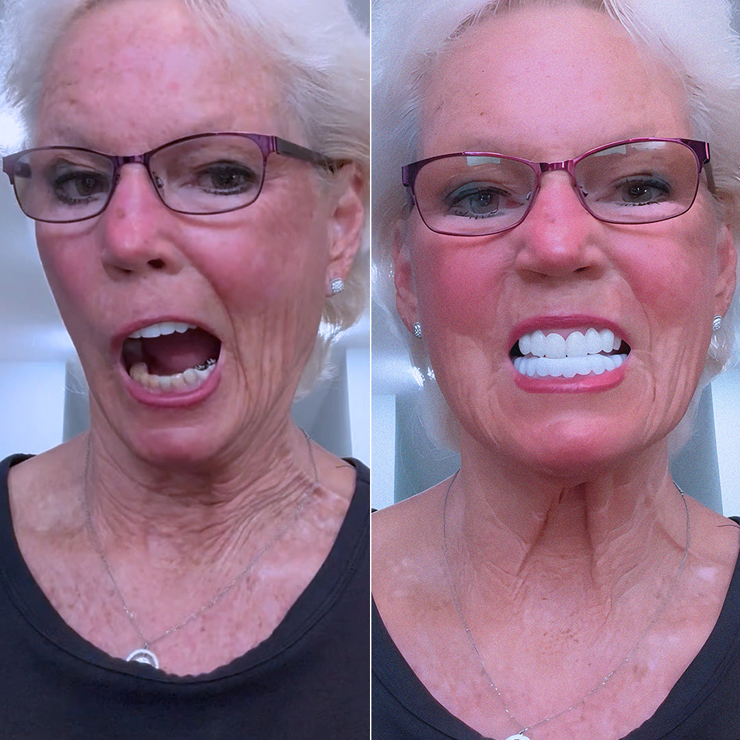 Una nueva sonrisa sin arruinarse