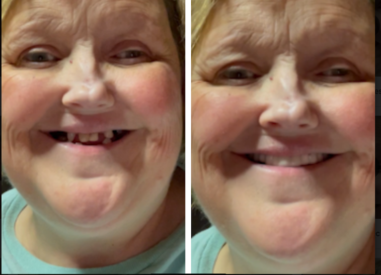 Pop On Veneers cambia las reglas del juego.