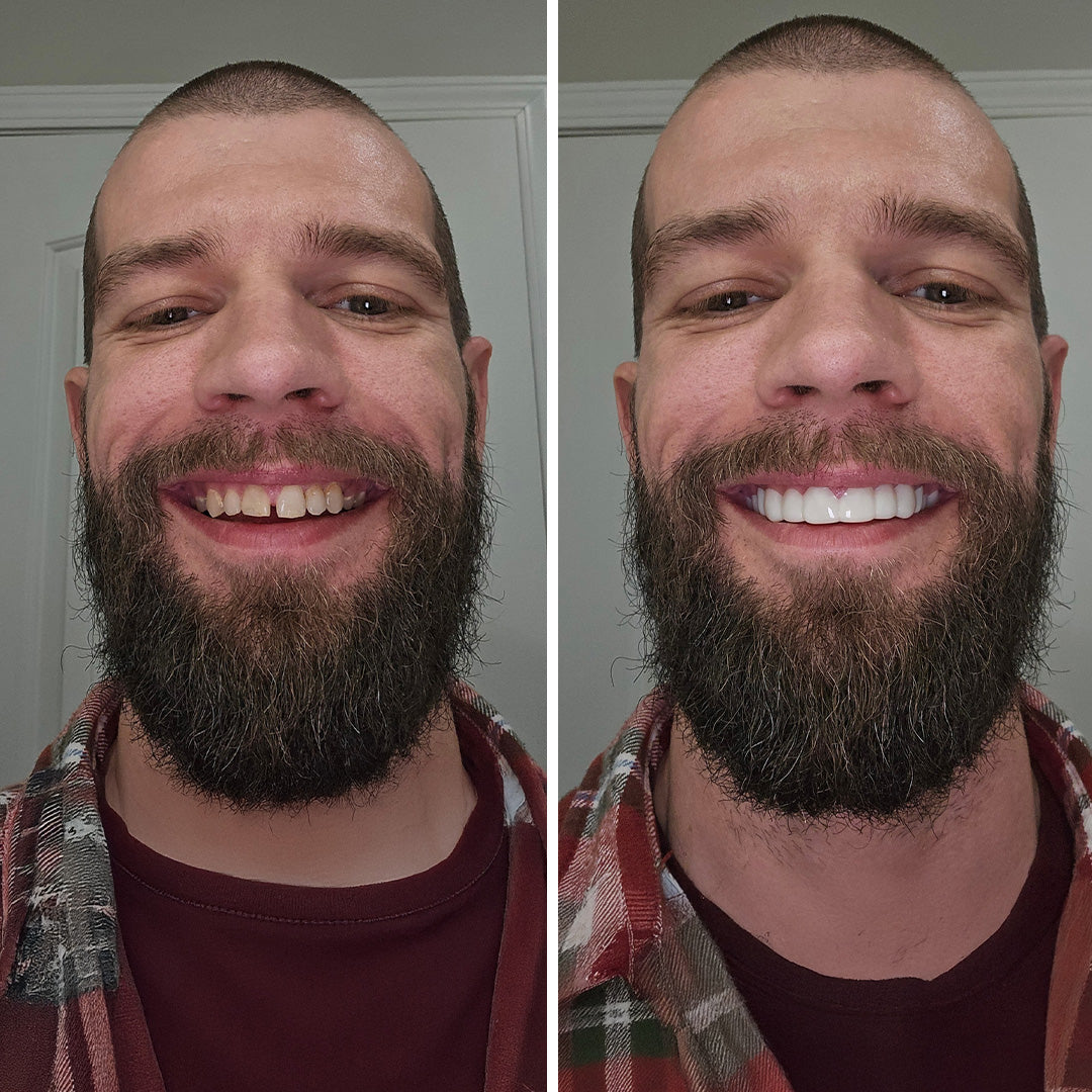 ¡Estas carillas son LEGÍTIMAS!