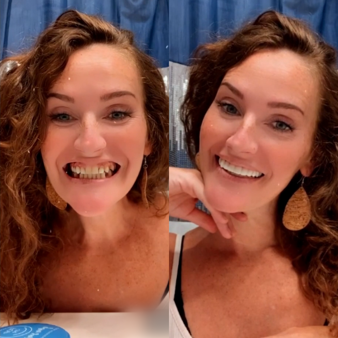 ¡Súper emocionado por mi nueva sonrisa!