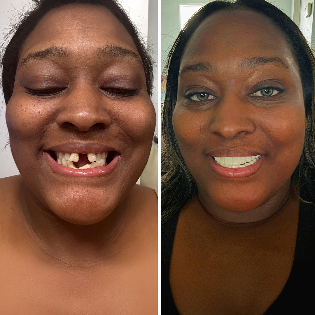 Bring your smile back instantly