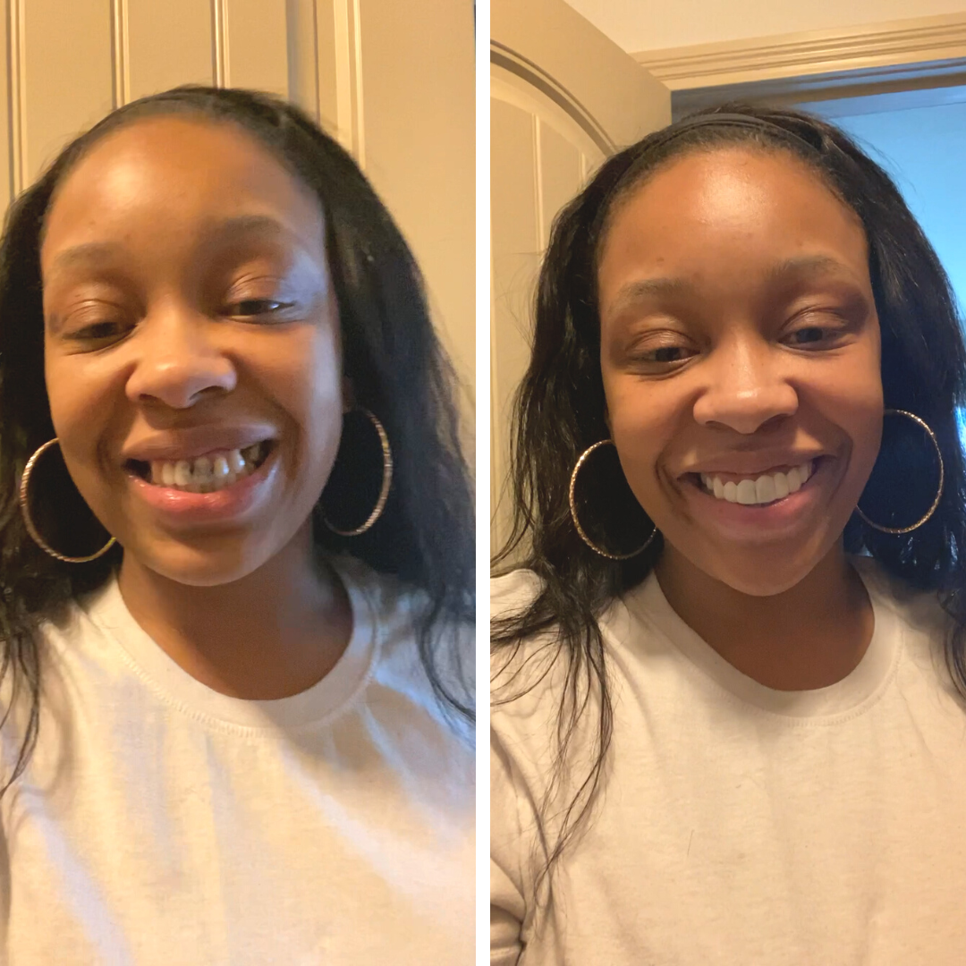 ¡Sonrisa increíble con Pop On!