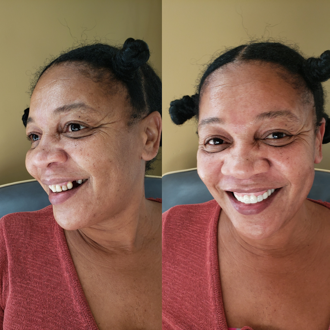 Puedo comer con mis carillas.