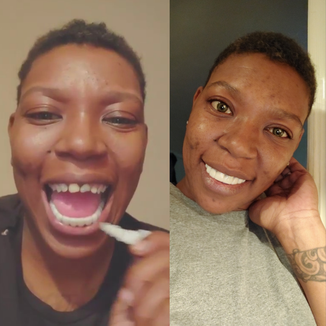 ¡¡Me encanta!! ¡¡Estoy muy feliz con mi nueva sonrisa!! 🤩