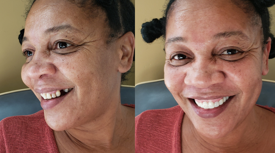 Celebrating Smiles Page 20 Pop on Veneers