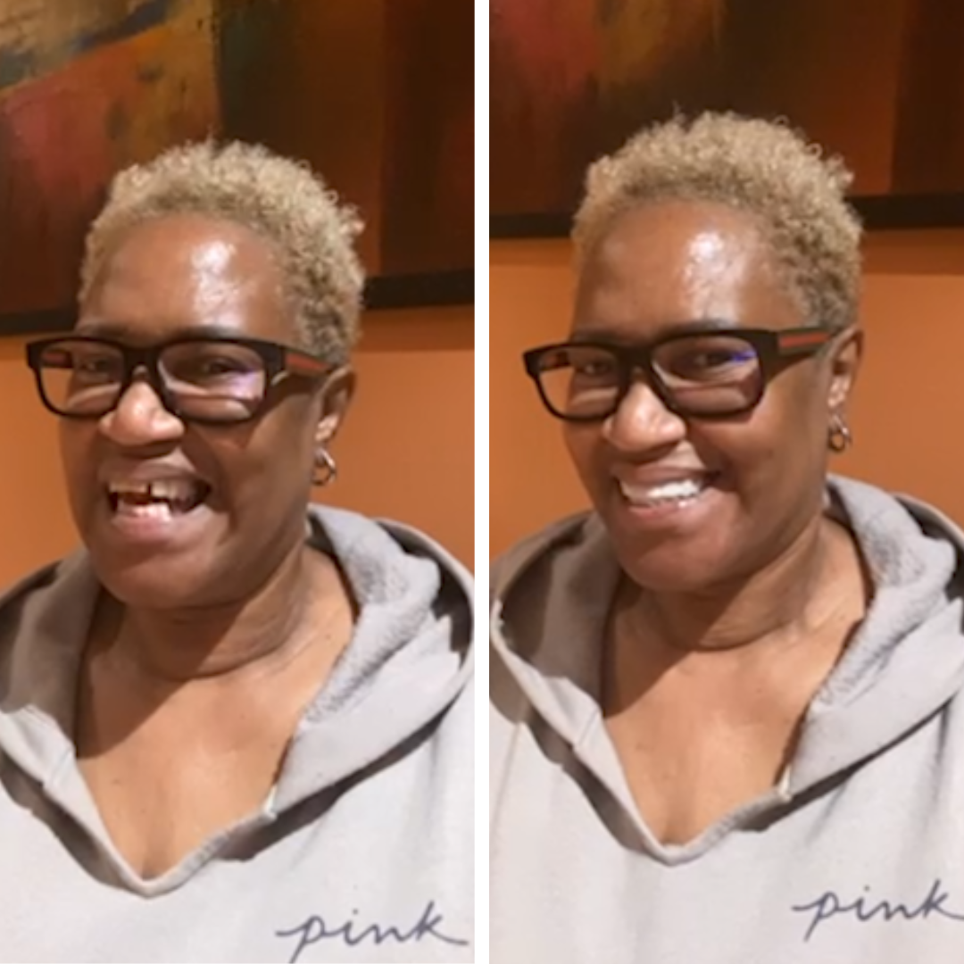 ¡Tan impresionado con Pop On Veneers!