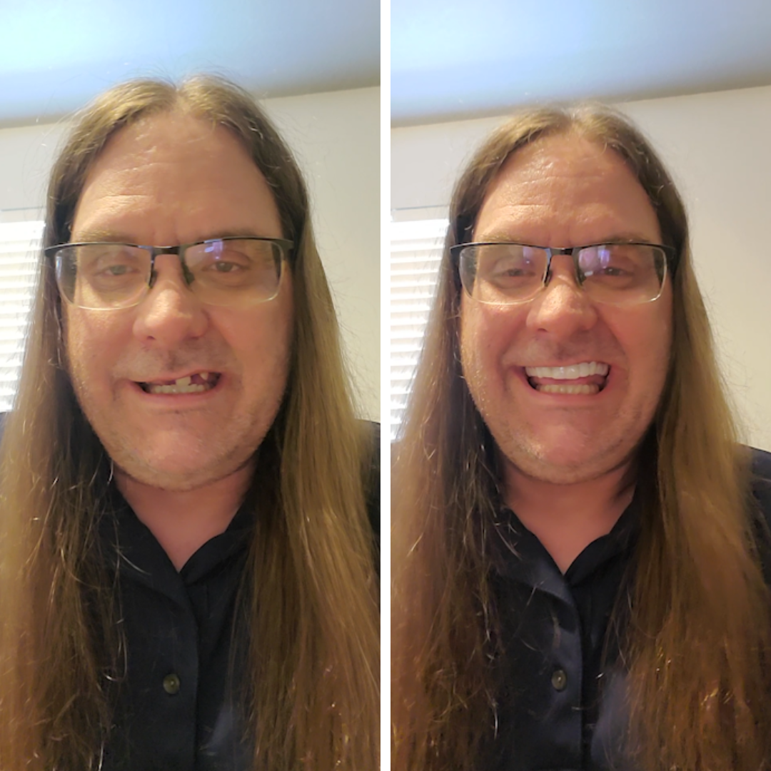 Ahora hay una gran diferencia en mi sonrisa.