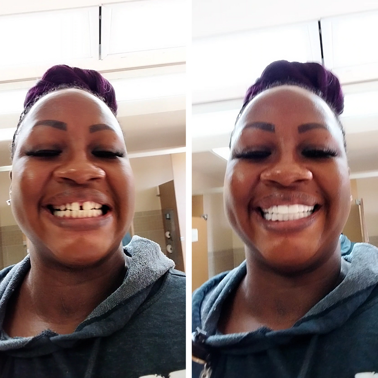 I’ve got a million dollar smile!- Deshonda G – Pop On Veneers