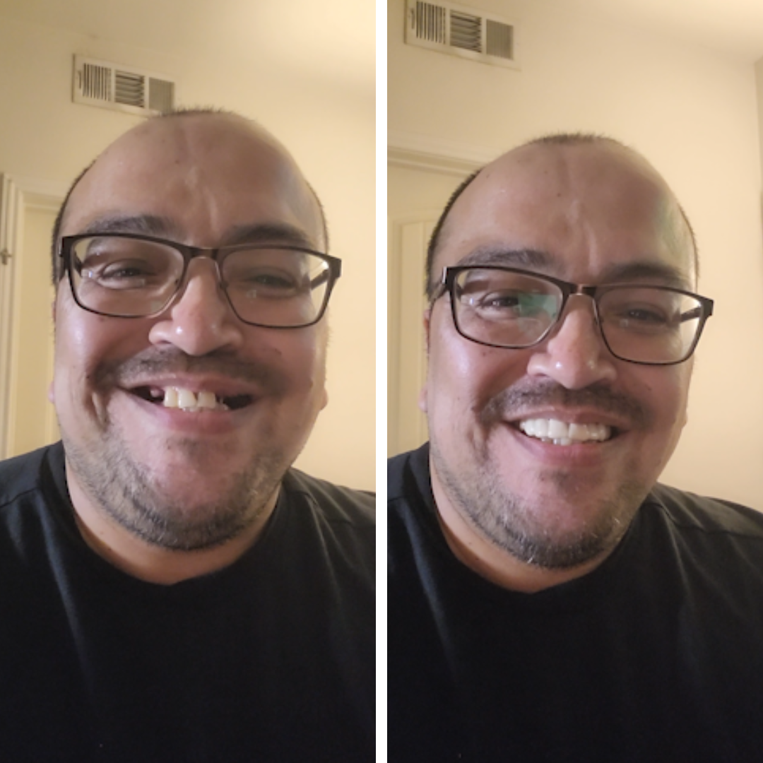 ¡Pop On Veneers lo hace fácil!