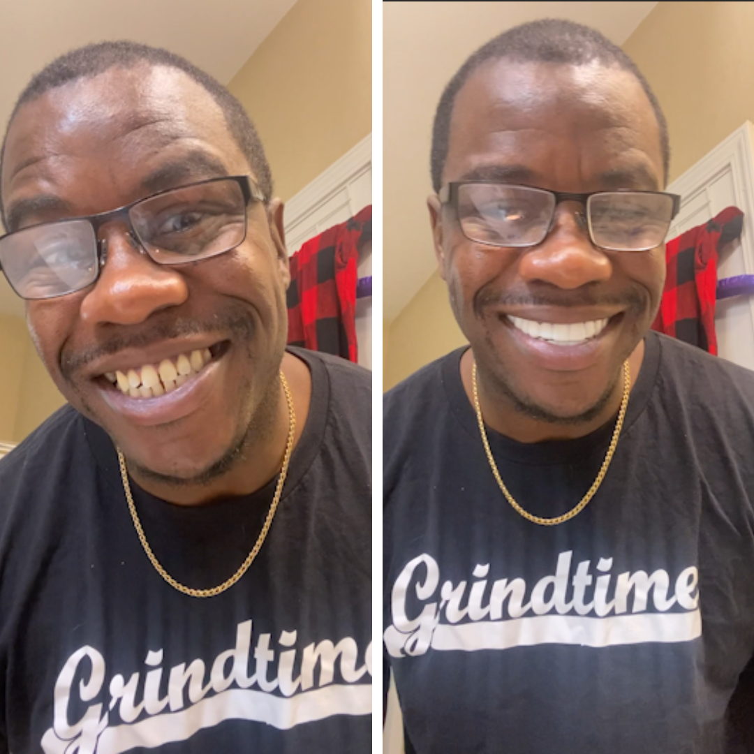 ¡Las carillas Pop On facilitan la sonrisa!