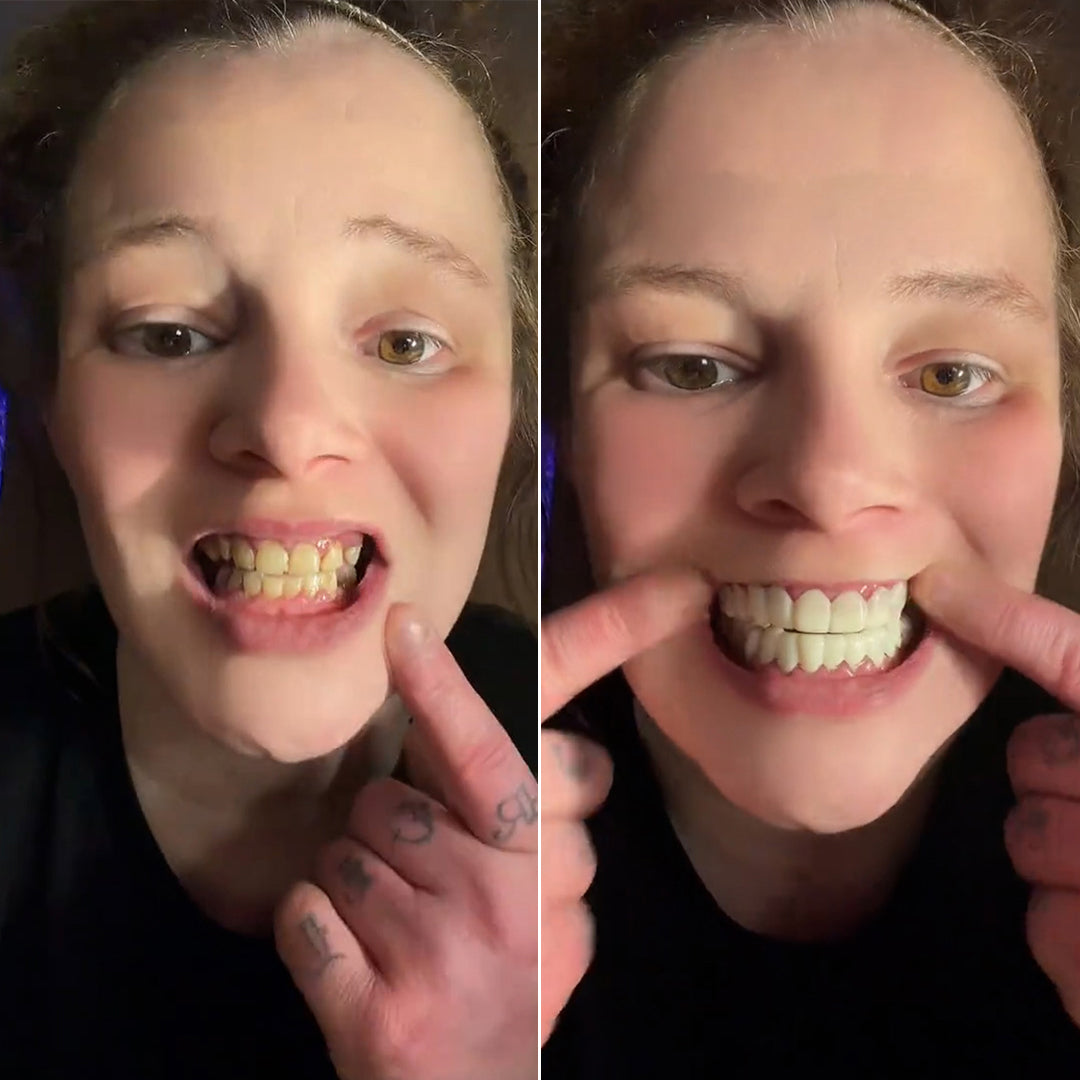 These veneers are a lifesaver