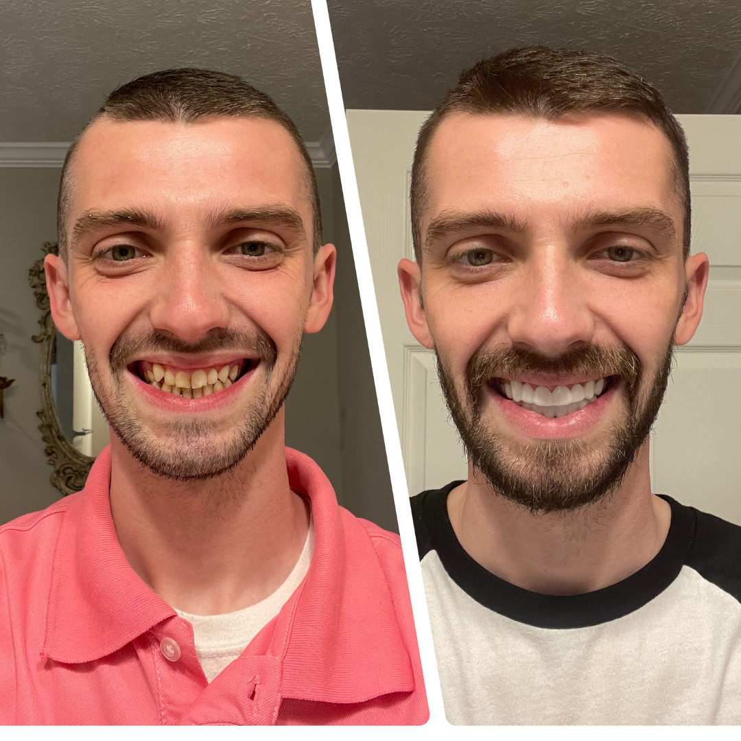 Blanqueamiento fácil