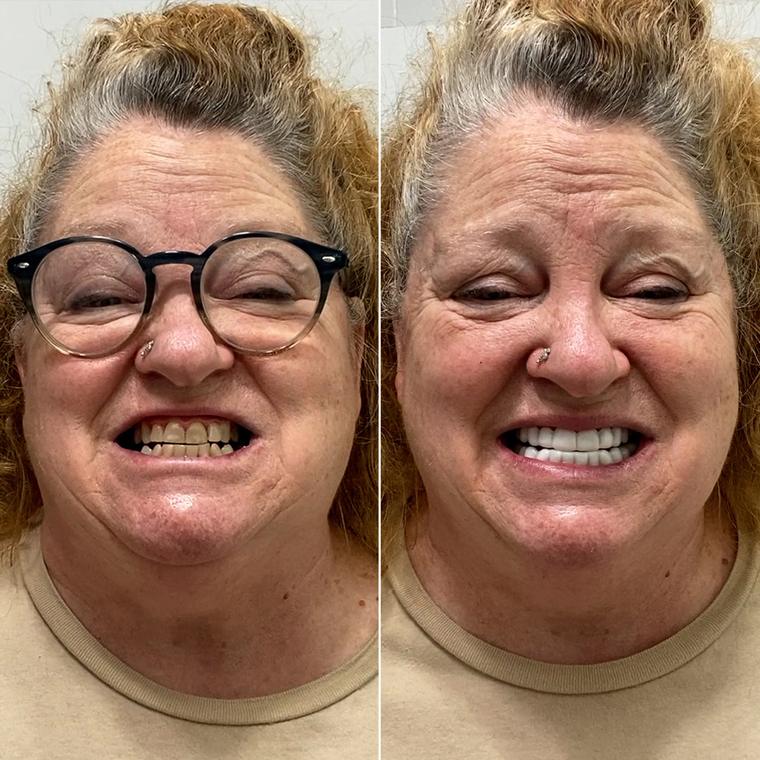 Pop On Veneers changed my life