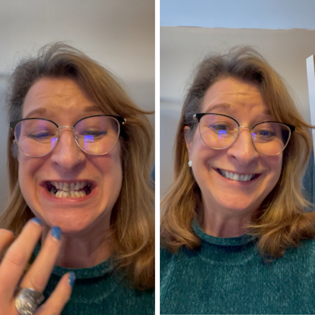 ¡Las carillas Pop On me dieron confianza!