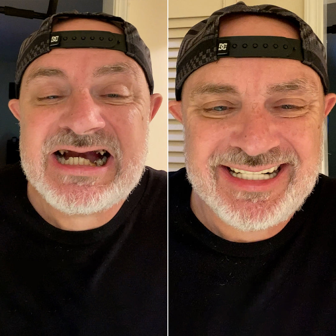 I love my Pop On Veneers!