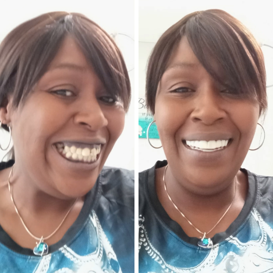 ¡Me encantan mis Pop On Veneers!