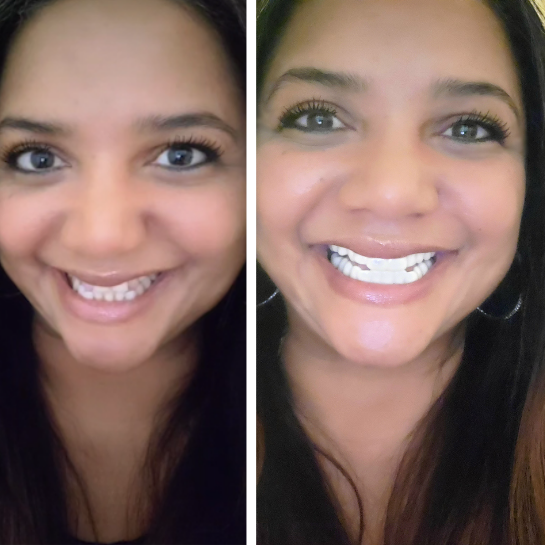 ¡Sonrisa de bling, bling!