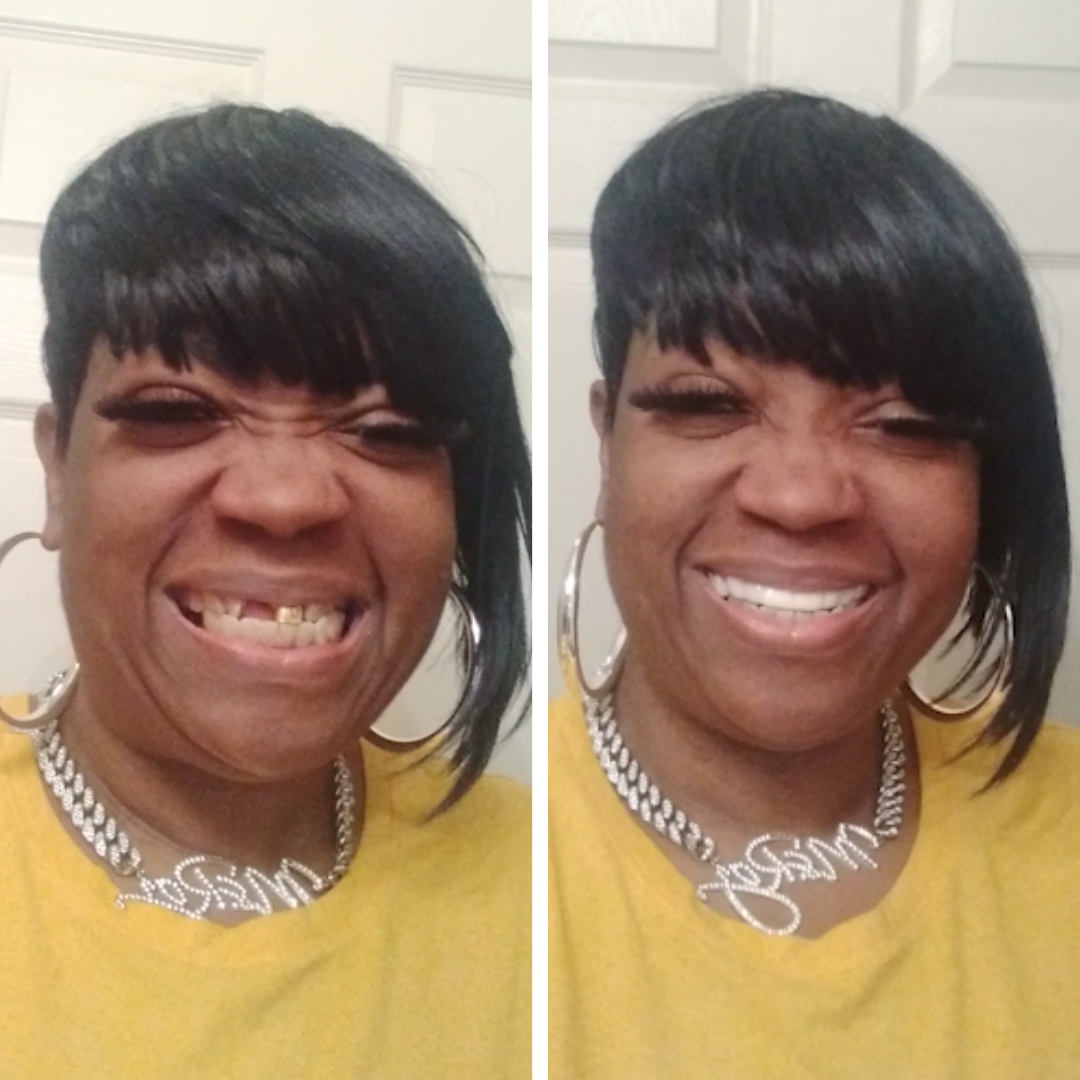 ¡WOW! ¡Las Carillas Pop On son increíbles!