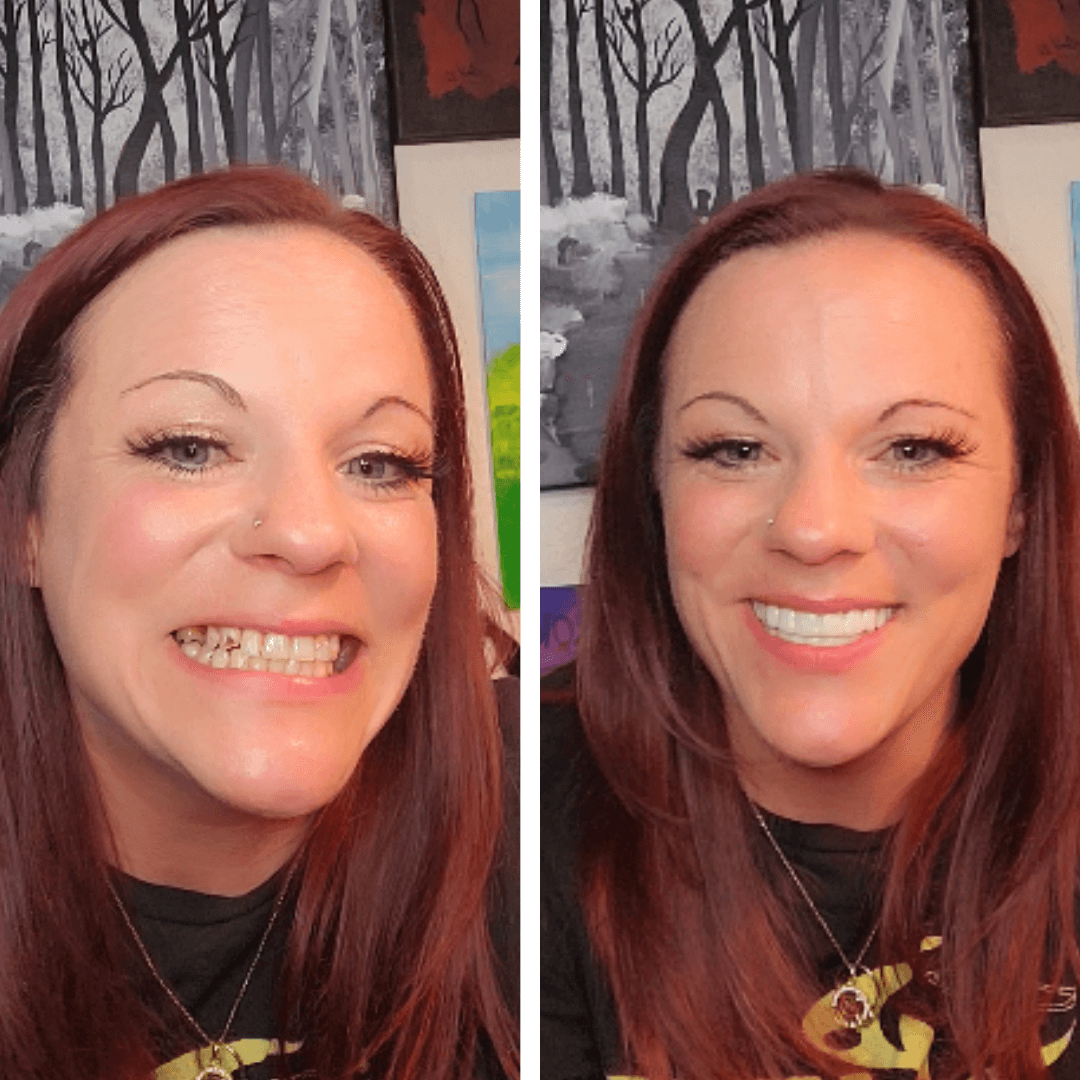 ¡Ahora puedo sonreír en las fotos!